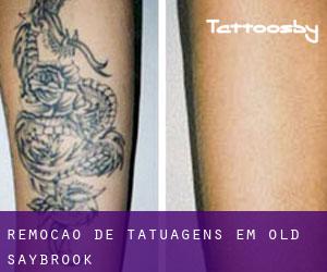 Remoção de tatuagens em Old Saybrook