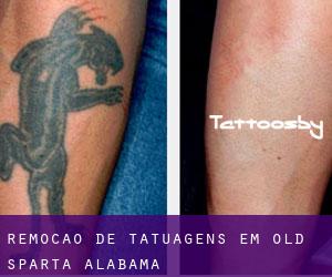 Remoção de tatuagens em Old Sparta (Alabama)