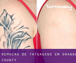 Remoção de tatuagens em Orange County