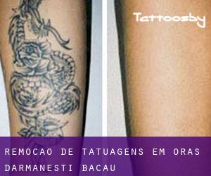 Remoção de tatuagens em Oraş Dãrmãneşti (Bacău)