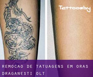 Remoção de tatuagens em Oraş Drãgãneşti-Olt