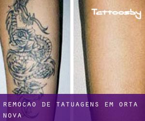 Remoção de tatuagens em Orta Nova