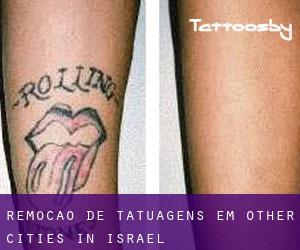 Remoção de tatuagens em Other Cities in Israel