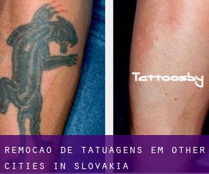 Remoção de tatuagens em Other Cities in Slovakia