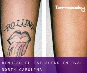 Remoção de tatuagens em Oval (North Carolina)