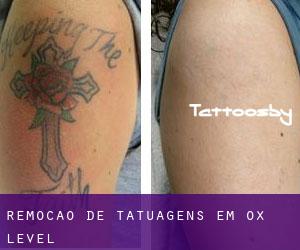 Remoção de tatuagens em Ox Level