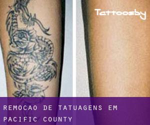 Remoção de tatuagens em Pacific County