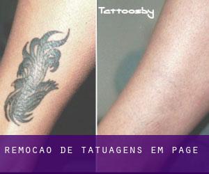 Remoção de tatuagens em Page