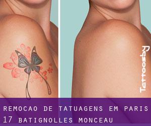 Remoção de tatuagens em Paris 17 Batignolles-Monceau