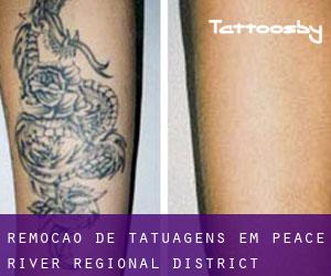 Remoção de tatuagens em Peace River Regional District