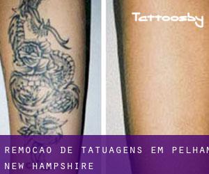 Remoção de tatuagens em Pelham (New Hampshire)