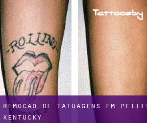 Remoção de tatuagens em Pettit (Kentucky)