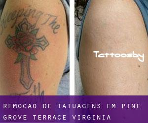 Remoção de tatuagens em Pine Grove Terrace (Virginia)