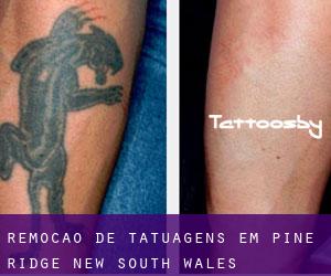 Remoção de tatuagens em Pine Ridge (New South Wales)