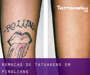 Remoção de tatuagens em Pingliang