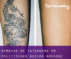 Remoção de tatuagens em Politischer Bezirk Bregenz