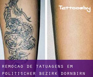 Remoção de tatuagens em Politischer Bezirk Dornbirn