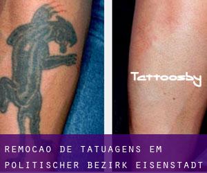 Remoção de tatuagens em Politischer Bezirk Eisenstadt