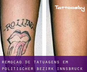 Remoção de tatuagens em Politischer Bezirk Innsbruck