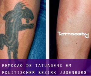 Remoção de tatuagens em Politischer Bezirk Judenburg