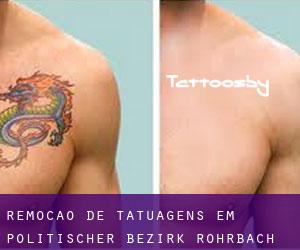 Remoção de tatuagens em Politischer Bezirk Rohrbach