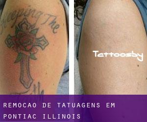 Remoção de tatuagens em Pontiac (Illinois)