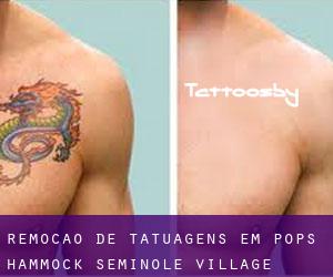 Remoção de tatuagens em Pops Hammock Seminole Village
