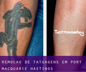Remoção de tatuagens em Port Macquarie-Hastings