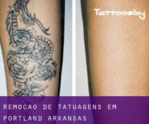 Remoção de tatuagens em Portland (Arkansas)