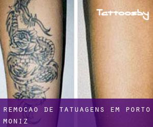 Remoção de tatuagens em Porto Moniz