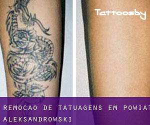 Remoção de tatuagens em Powiat aleksandrowski