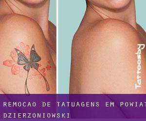 Remoção de tatuagens em Powiat dzierżoniowski