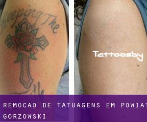 Remoção de tatuagens em Powiat gorzowski