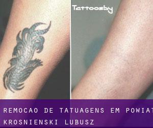 Remoção de tatuagens em Powiat krośnieński (Lubusz)