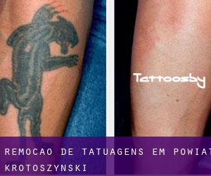 Remoção de tatuagens em Powiat krotoszyński