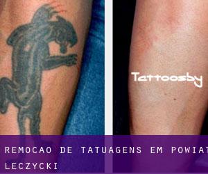 Remoção de tatuagens em Powiat łęczycki