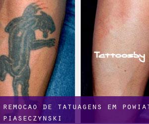 Remoção de tatuagens em Powiat piaseczyński