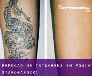 Remoção de tatuagens em Powiat starogardzki