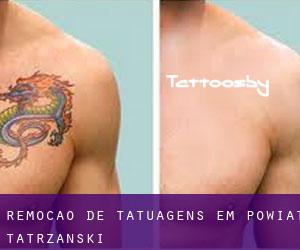 Remoção de tatuagens em Powiat tatrzański