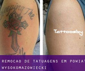 Remoção de tatuagens em Powiat wysokomazowiecki