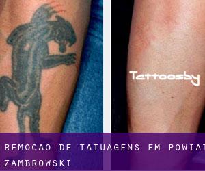 Remoção de tatuagens em Powiat zambrowski
