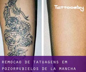 Remoção de tatuagens em Pozorrubielos de la Mancha
