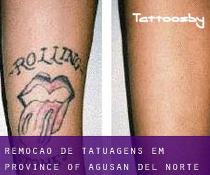 Remoção de tatuagens em Province of Agusan del Norte
