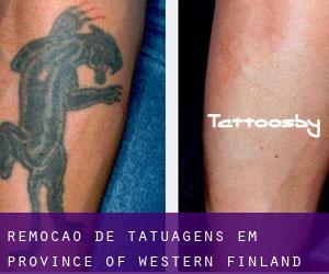 Remoção de tatuagens em Province of Western Finland