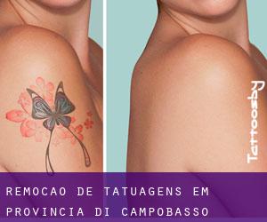 Remoção de tatuagens em Provincia di Campobasso