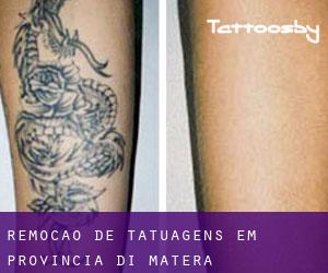 Remoção de tatuagens em Provincia di Matera