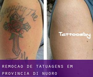 Remoção de tatuagens em Provincia di Nuoro