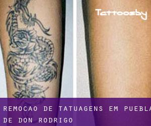 Remoção de tatuagens em Puebla de Don Rodrigo