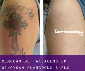 Remoção de tatuagens em Qingyuan (Guangdong Sheng)