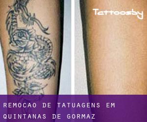 Remoção de tatuagens em Quintanas de Gormaz